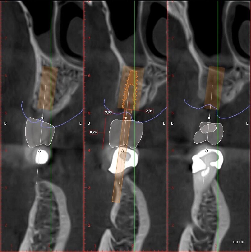 Fig. 6_Pianificazione implantare protesicamente guidata dell’elemento 2.5.