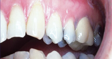 Root recession: Aesthetic and predictable elimination