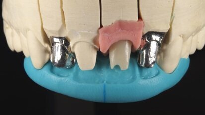 Złożona technika ceramiki i łącznik hybrydowy Ti/Zr w rozwiązaniu trudnego przypadku estetycznego