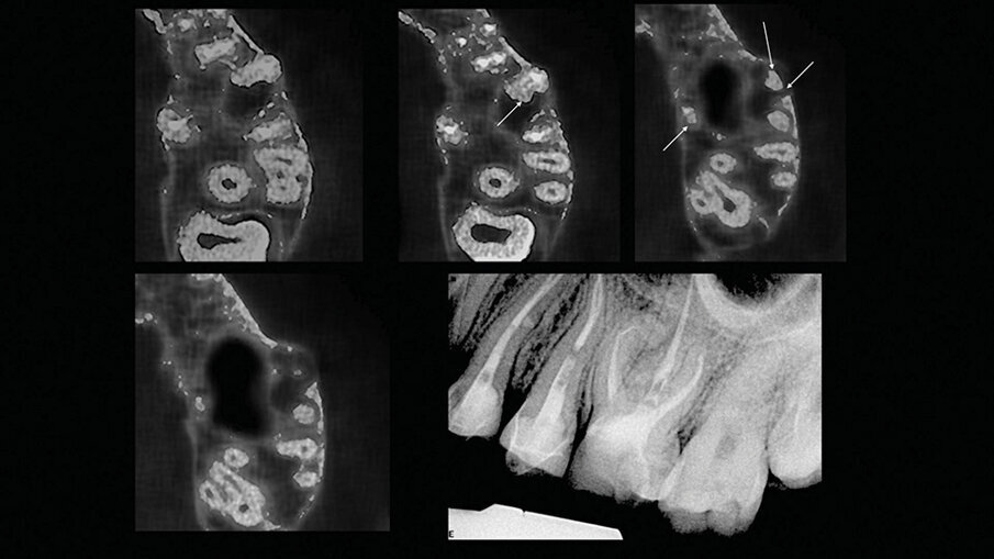 Slučaj 3 – Slika br. 8: Preoperativni CBCT sken 