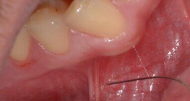 Kilka (z wielu) technik bezpiecznego i bezbolesnego znieczulania