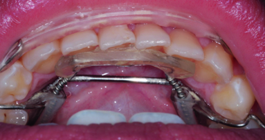 Conservative smile design for the general dentist