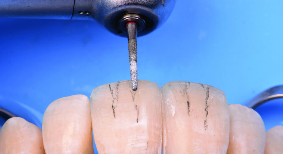 Fig 17. Anatomical contouring of labial grooves with Fine Diamond Point