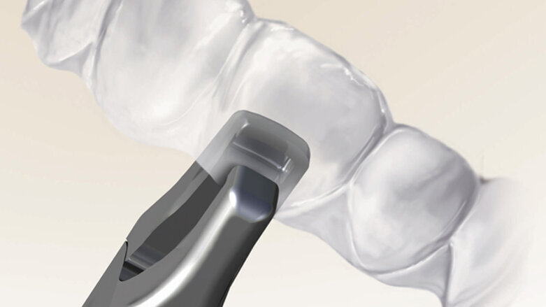 Kreativní doplňky ke zvýšení prediktability léčby fóliovými aparáty