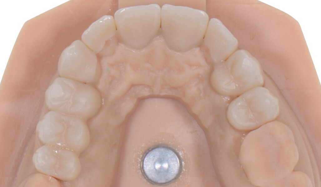 Fig. 15: Occlusal view of the restorations.