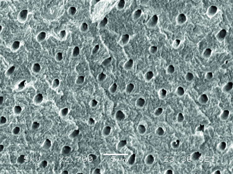 Fig. 1b: Scanning electron microscope (SEM) images of unprotected open dentine tubuli before treatment with nHAp agent by PrevDent.