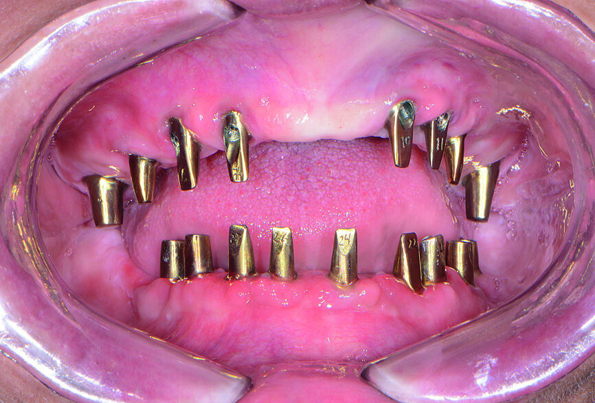 Fig. 19: Inclusive CAD/CAM abutments.