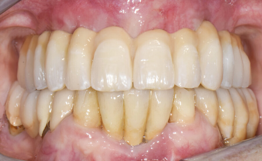 Fig. 14 - Protesi definitiva tipo Toronto in sede (a 7 giorni dall’intervento chirurgico).