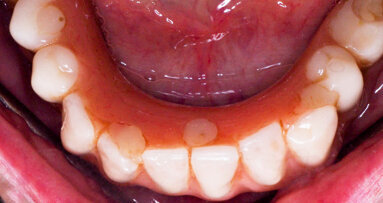 Surgical management of peri-implantitis