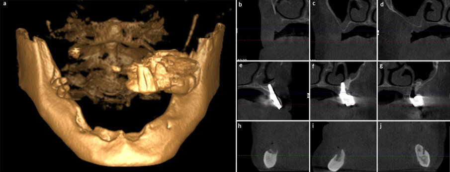 Fig. 4 - Tagli del CBCT. 4a: ricostruzione 3D dei mascellari, dove si evidenziano l’atrofia completa e la totale assenza di anatomia del primo quadrante. 4b: primo quadrante zona premascellare, dove si osserva una comunicazione oro-antrale. 4c: primo quadrante zona premolare. 4d: primo quadrante zona molare. 4e: secondo quadrante zona premascellare. 4f: secondo quadrante zona premolare. 4g: secondo quadrante zona molare. 4h: forame mentoniero quarto quadrante. 4i: zona mandibolare anteriore. 4j: forame mentoniero terzo quadrante. 