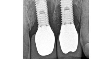 Terapie periimplantitidy při použití resorbovatelného, náhradního kostního materiálu