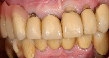 Ricostruzione completa dell’arcata mascellare edentula con il CAMLOG® Guide System