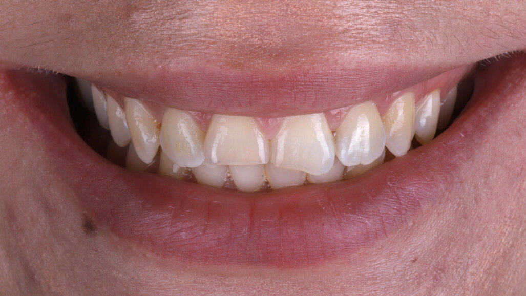 From trauma to harmony: A minimally invasive approach to anterior aesthetics