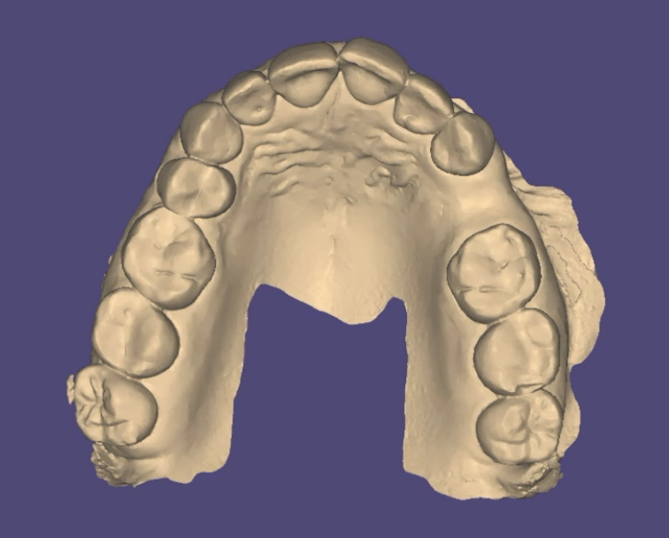 Fig. 3_Impronta ottica intraorale, il dente viene rimosso virtualmente.