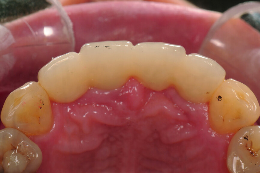 Fig. 45: Protrusive contact just after delivery; only tooth #11 achieved contact (12 μm occluding paper, black).