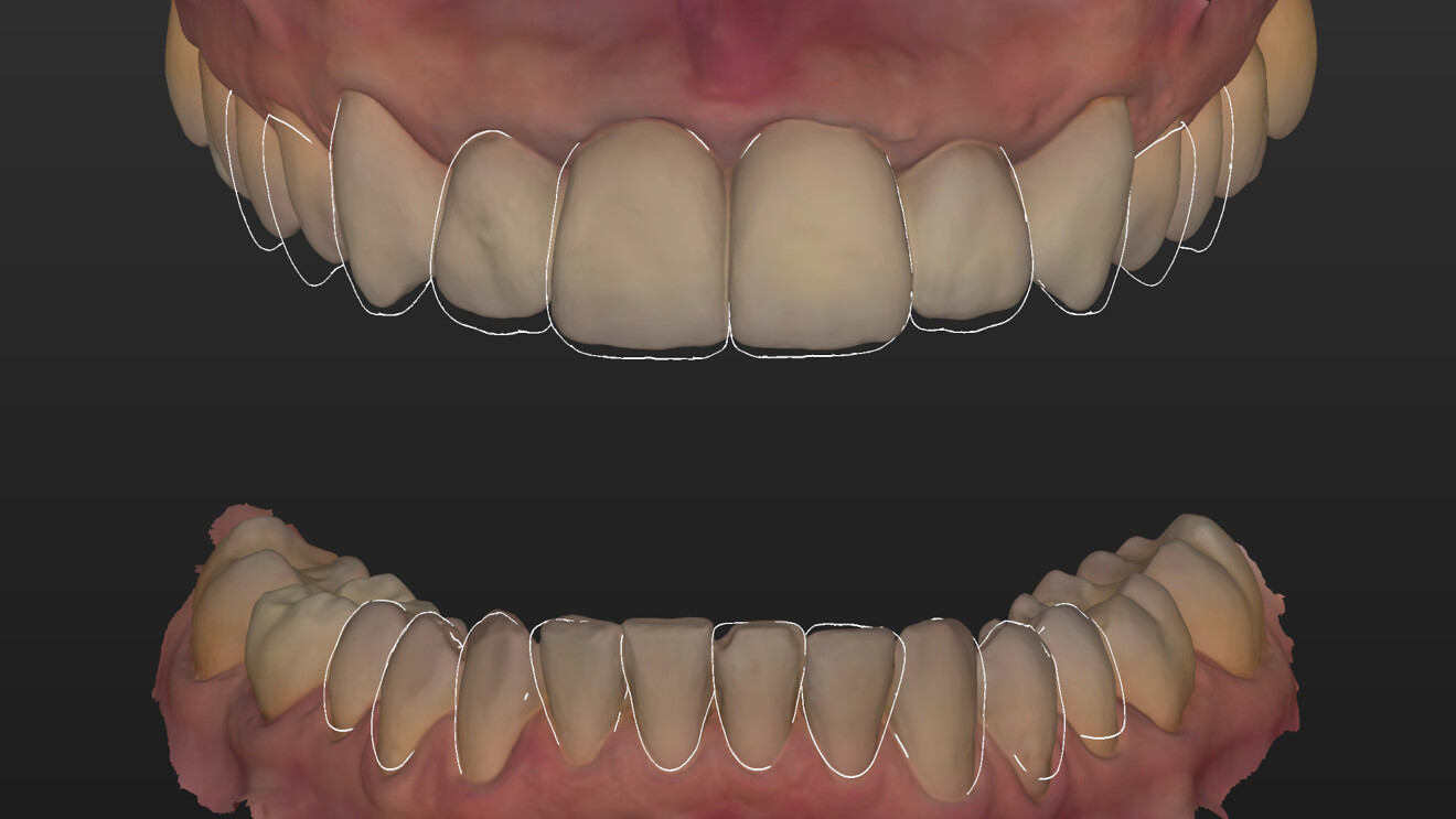 Fig. 3: Computer-aided wax-up in the maxilla and mandible based on the digital smile design.