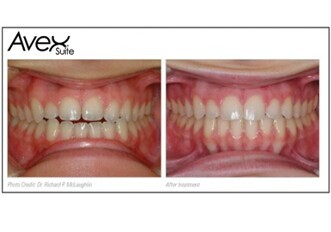 Board standard results through Avex Suite