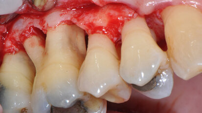 Full Mouth Instrumentation: l’efficacia in terapia antibiotica