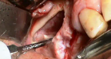 La chirurgia piezoelettrica del seno mascellare: indicazioni cliniche e descrizione di un case series