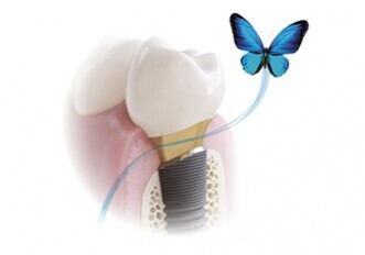 Dentsply Sirona – OsseoSpeed Profile EV