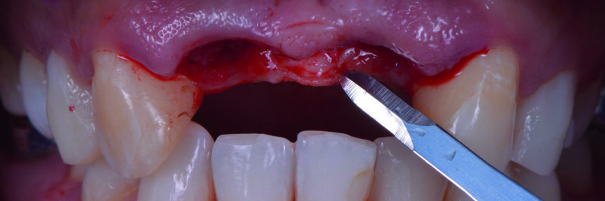 Fig. 13 : Incision supracrestale, légèrement du côté palatin. 