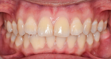 Une étude révèle la nature compétitive des bactéries