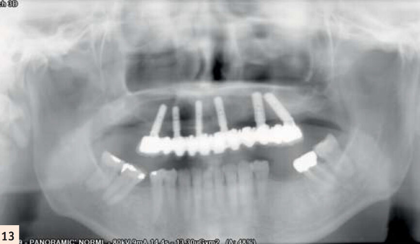 Armature Cadcam Createch Straumann. Noter l’ossification autour des implants ayant soulevé la membrane sinusienne.