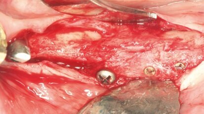 Augmentacja z wykorzystaniem indywidualnie frezowanego przeszczepu kości