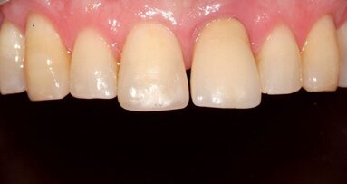 Ästhetische Versorgungen mit Kronen und Brücken im Frontzahngebiet