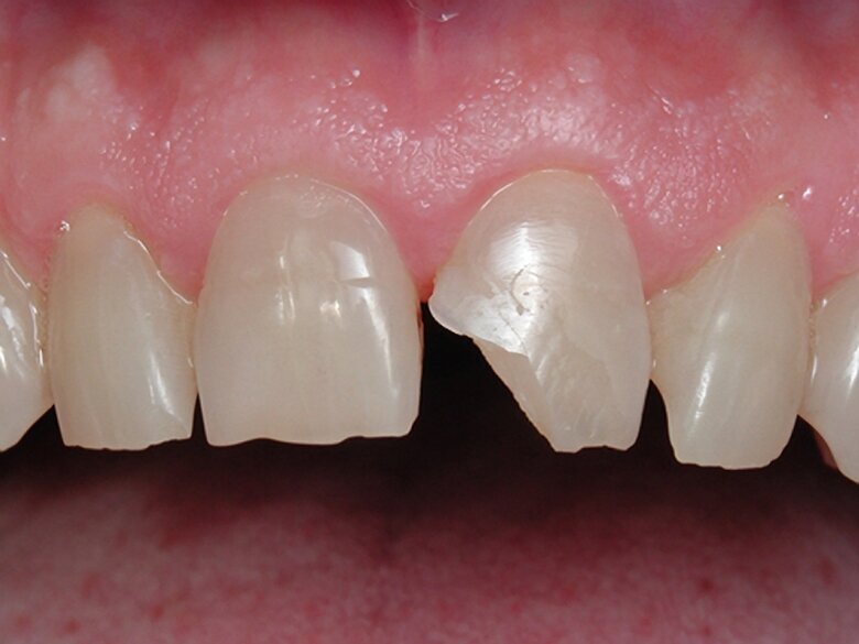Figura 1. Diente central con fractura de ángulo.