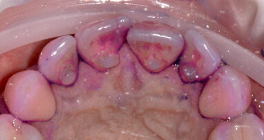 Applicazione del protocollo GBT nel trattamento di un caso di gengivite