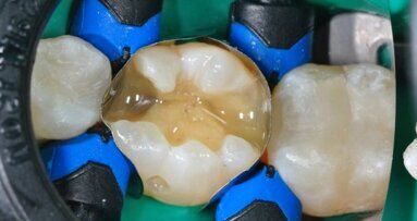 Tetric EvoFlow Bulk Fill: een tijdbesparende workflow