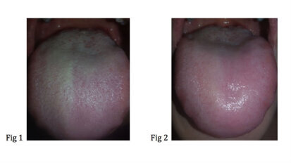 Trattamento con ossigeno terapia locale di un caso di lingua villoso