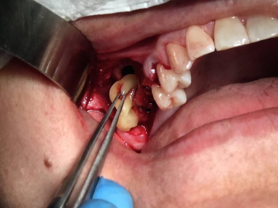 Fig. 19 - Sinus lifting: chiusura della finestra ossea con membrana di gel piastrinico A-PRF.