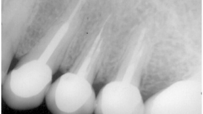 La importancia del tercio apical del conducto