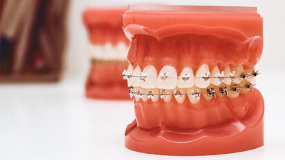 IGES-Gutachten zum Nutzen von KFO-Behandlungen falsch interpretiert