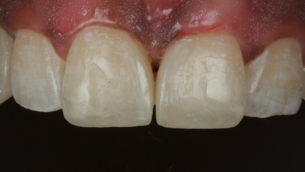 Fig 22. And final polish was achieved with the help of Soflex Disks and Spirals from 3M.