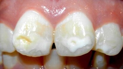 Colgate lanza un Advisory Board sobre mancha blanca en ortodoncia