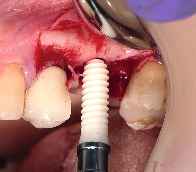 Fig. 38 : Pose de l’implant deux pièces en céramique au niveau tissulaire. 
