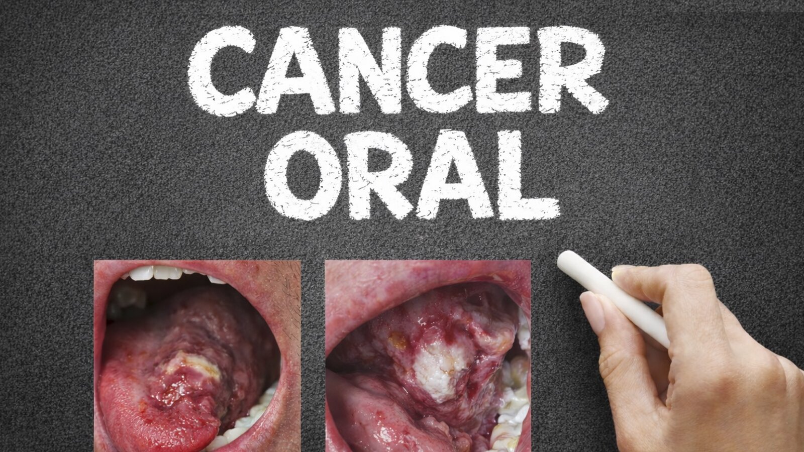 Cómo prevenir la mortalidad del cáncer oral