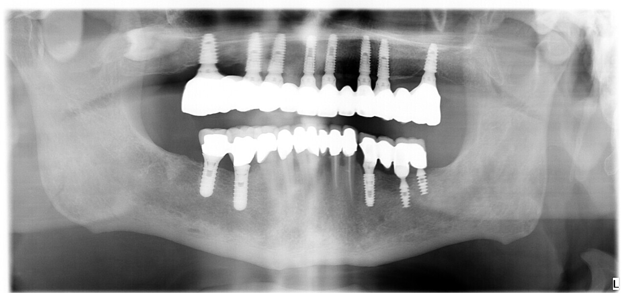 Fig. 22: One-year dental panoramic tomogram.