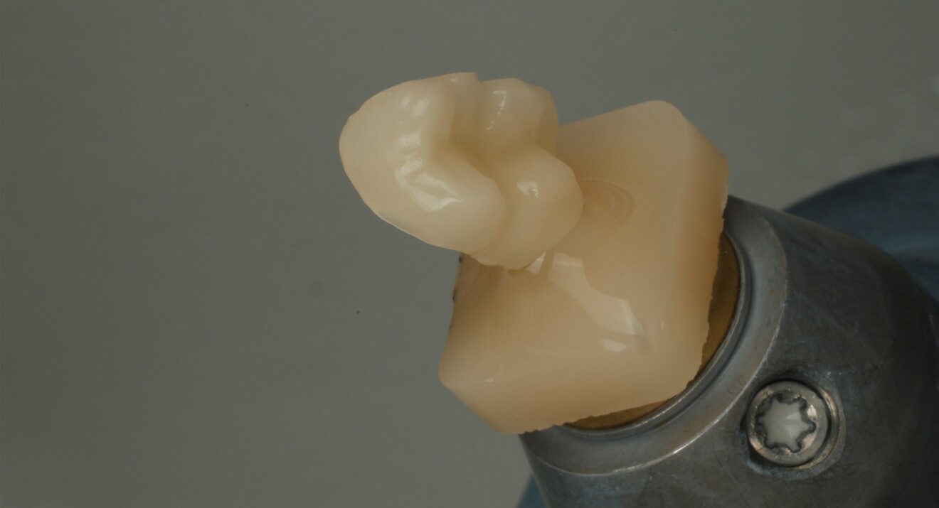 Fig. 2b: Digitally designed and milled onlay fabricated from a composite block. 