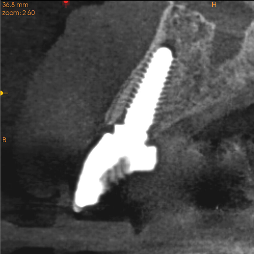 Fig. 28a: The post-op cross-sectional view clearly illustrated the position of the implant (a), the definitive restoration located palatal to the root membrane (b),
as outlined in yellow (red arrows).