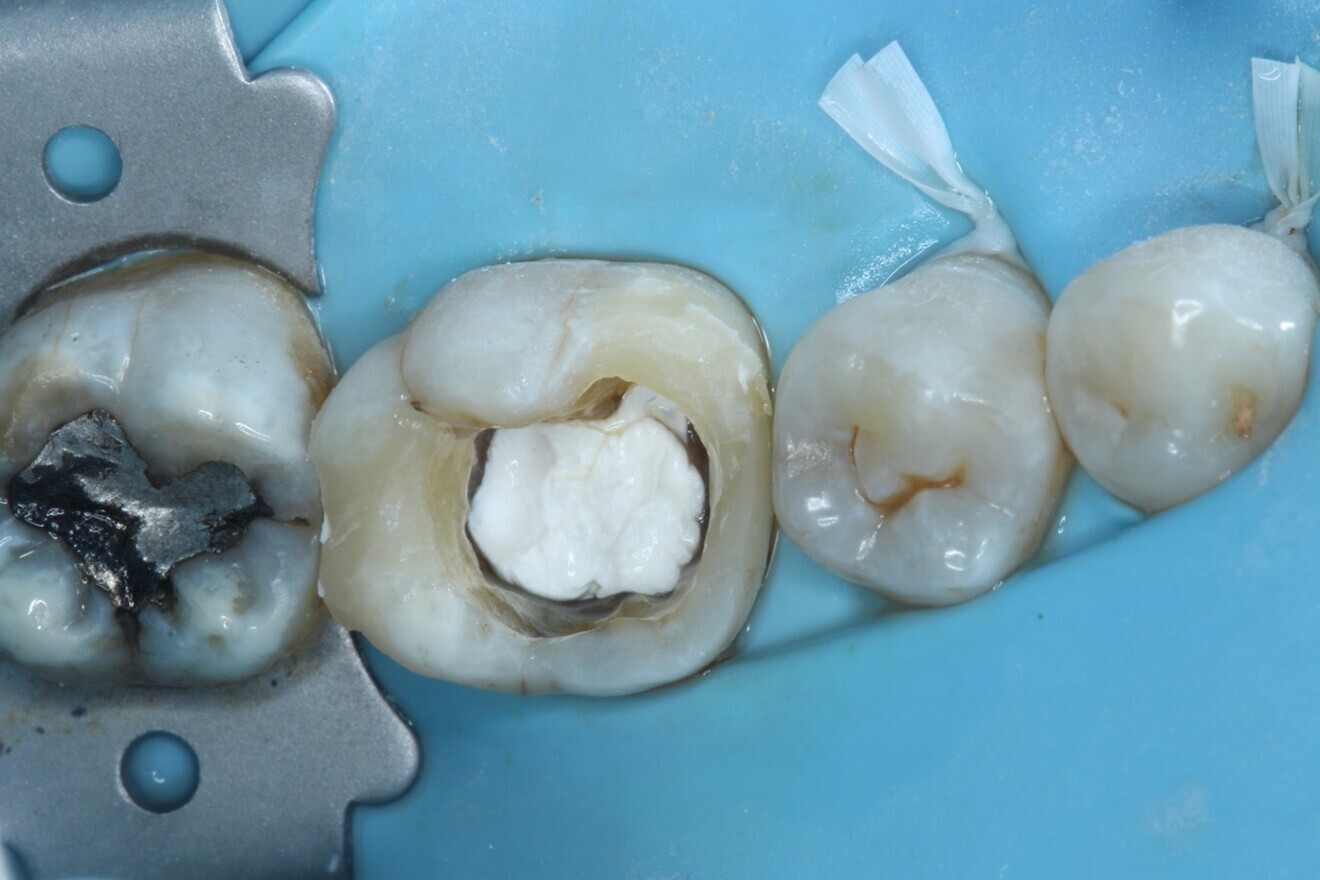 Fig. 7: After deep marginal elevation and restoration of the marginal ridges of tooth #36.