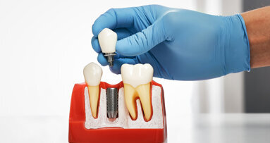China caps cost of dental implant treatment