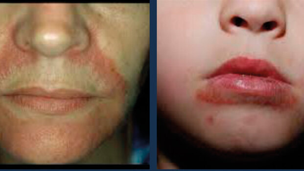 Dermatite periorale? Un’arma terapeutica in più con i trattamenti integrati