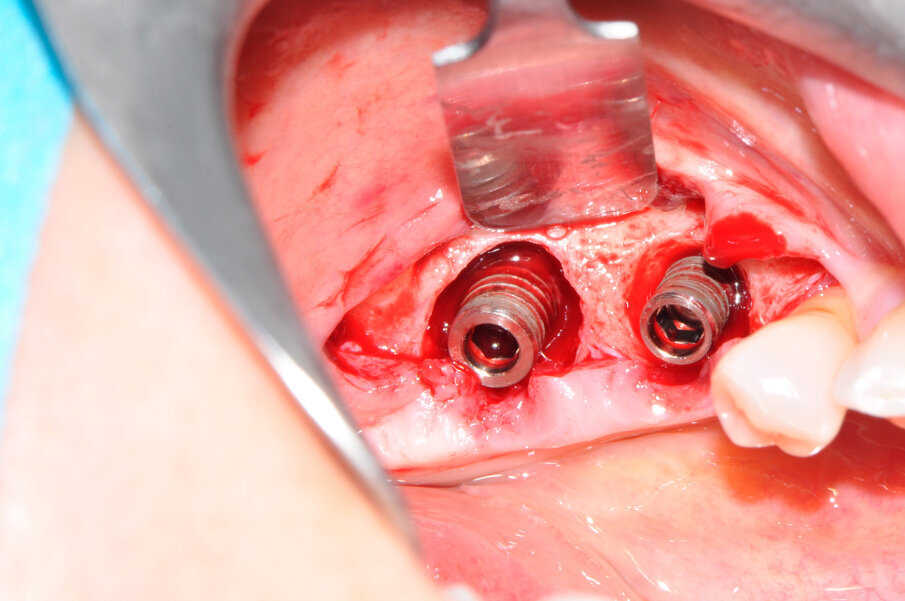 Fig. 3 - I due difetti perimplantari all’apertura del lembo.