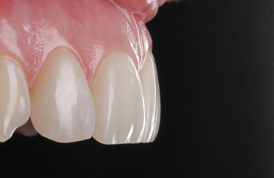 Fig. 11: Close-up of the veneer surface which shows the good adaption of the natural surface of the teeth.