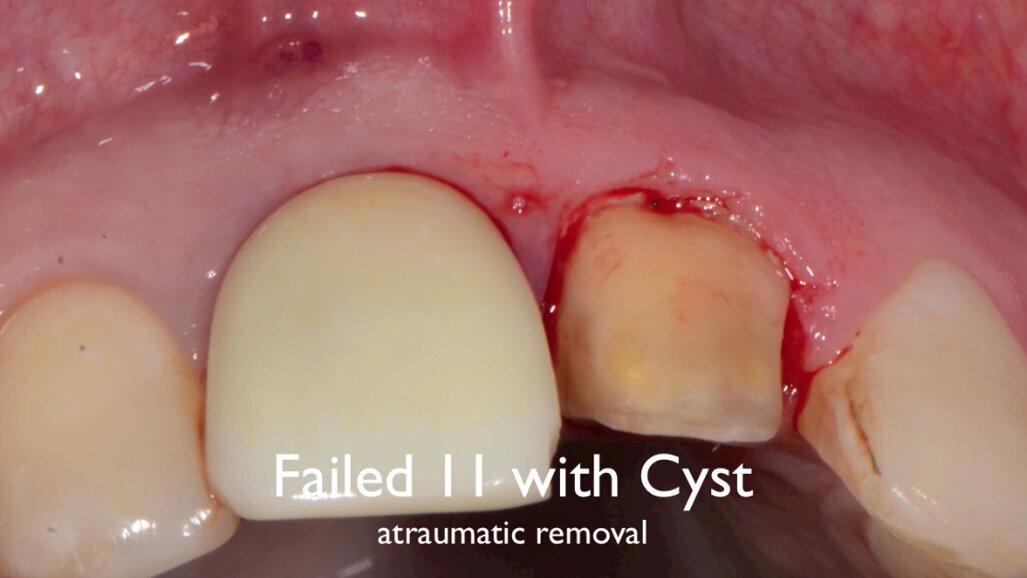 Τοποθέτηση μοσχεύματος ethoss και εμφυτεύματος Paltop Conical Connection. Τοποθέτηση μοσχεύματος ethoss και εμφυτεύματος Paltop Conical Connection.