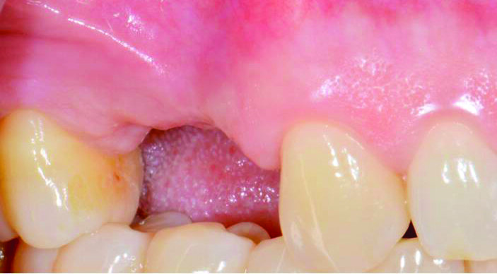 Fig. 2_Visione laterale della sella edentula in sede 14 e 15: è ben visibile la contrazione tissutale sull’aspetto vestibolare della cresta residua.